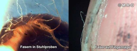 Morgellons-Faser 6